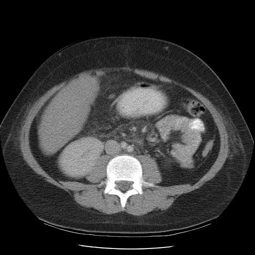 File:Non-Hodgkin lymphoma involving pelvis (Radiopaedia 21281-21197 A 36).jpg