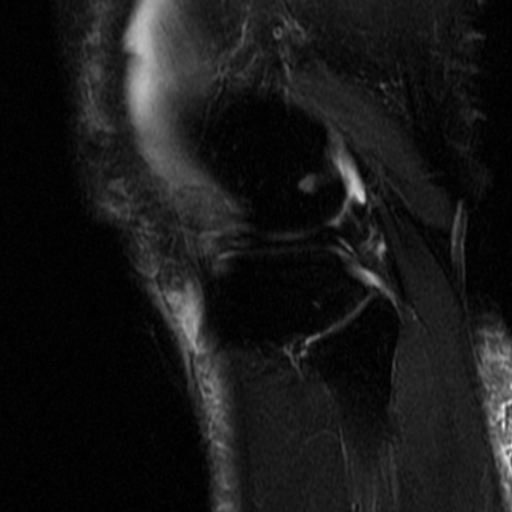 File:Non-displaced patella fracture (Radiopaedia 15932-15582 Sagittal T2 fat sat 16).jpg