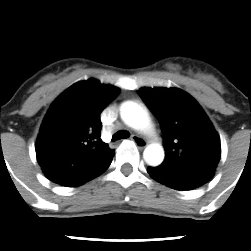 File:Non-small cell lung cancer with miliary metastases (Radiopaedia 23995-24193 A 17).jpg