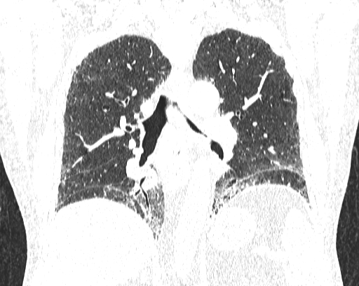 Non-specific interstitial pneumonia (NSIP) (Radiopaedia 68599-78228 Coronal lung window 58).jpg