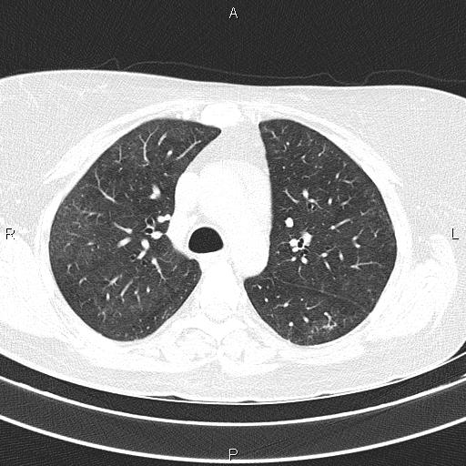 Non-specific interstitial pneumonia (Radiopaedia 83185-97567 Axial lung window 25).jpg