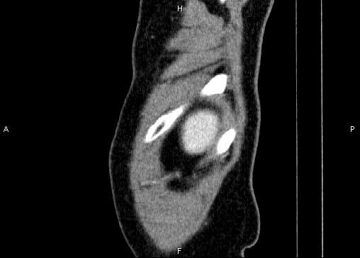 Non-syndromic pancreatic endocrine tumor (Radiopaedia 86958-103178 E 101).jpg