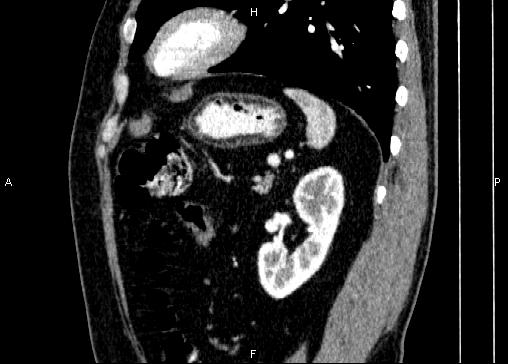 Non-syndromic pancreatic endocrine tumor (Radiopaedia 86958-103178 E 74).jpg