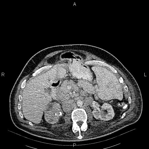 File:Non Hodgkin lymphoma in a patient with ankylosing spondylitis (Radiopaedia 84323-99621 B 36).jpg