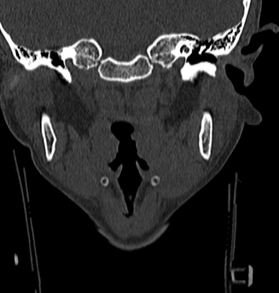 File:Normal CT cervical spine - 12-year-old (Radiopaedia 55352-61775 Coronal bone window 10).jpg