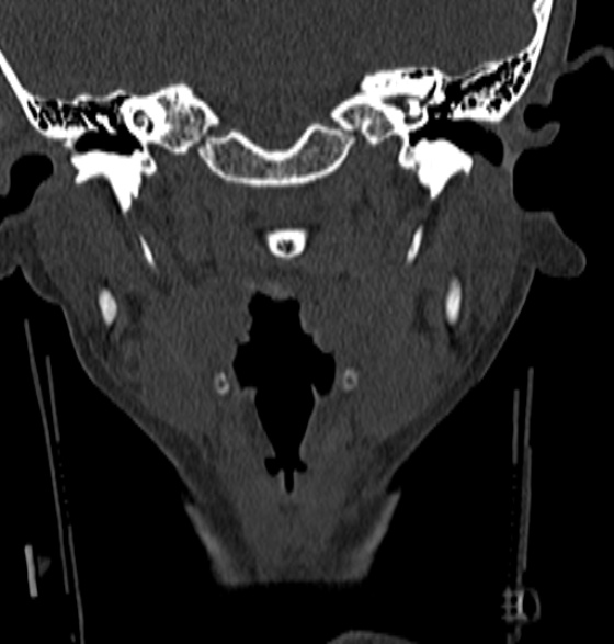 File:Normal CT cervical spine - 12-year-old (Radiopaedia 55352-61775 Coronal bone window 20).jpg