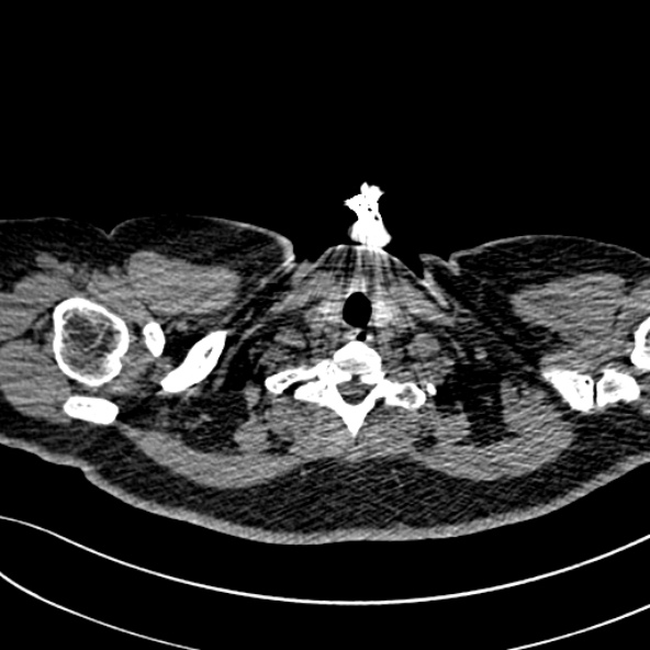 Normal CT chest- adult female (Radiopaedia 52522-58428 Axial non-contrast 6).jpg