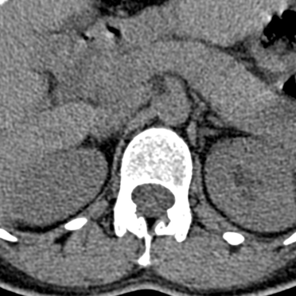 Normal CT lumbar spine (Radiopaedia 53981-60118 Axial non-contrast 14).jpg