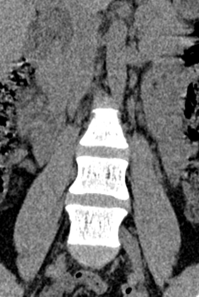 Normal CT lumbar spine (Radiopaedia 53981-60118 F 15).jpg