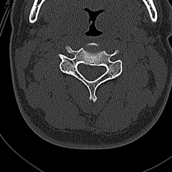 Normal CT of the cervical spine (Radiopaedia 53322-59305 Axial bone window 106).jpg