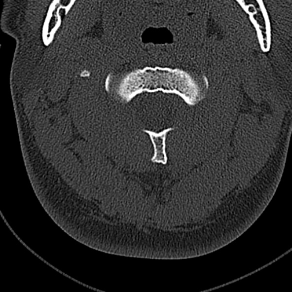 File:Normal CT of the cervical spine (Radiopaedia 53322-59305 Axial bone window 74).jpg