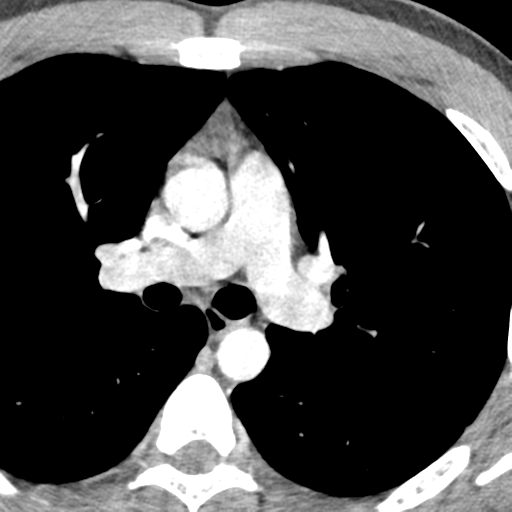 File:Normal CT pulmonary veins (pre RF ablation) (Radiopaedia 41748-44702 A 66).png