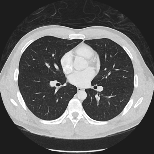 Normal CT pulmonary veins (pre RF ablation) (Radiopaedia 41748-44702 Axial lung window 25).png