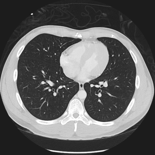 Normal CT pulmonary veins (pre RF ablation) (Radiopaedia 41748-44702 Axial lung window 36).png