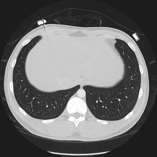 Normal CT pulmonary veins (pre RF ablation) (Radiopaedia 41748-44702 Axial lung window 58).png