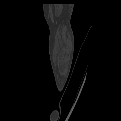 Normal CT tibia and fibula (Radiopaedia 51195-56848 Coronal non-contrast 64).jpg