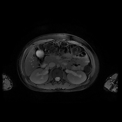 File:Normal MRI abdomen in pregnancy (Radiopaedia 88001-104541 D 20).jpg