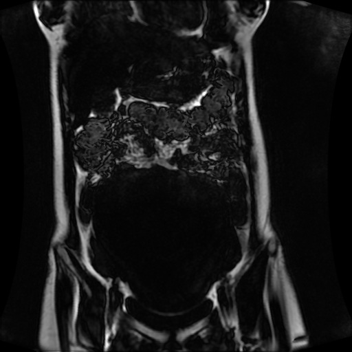 Normal MRI abdomen in pregnancy (Radiopaedia 88001-104541 N 50).jpg