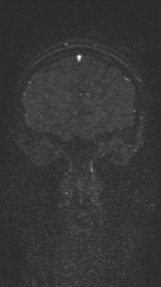 Normal MRI brain with MRV- teenager (Radiopaedia 49425-54553 Coronal MRV 54).jpg