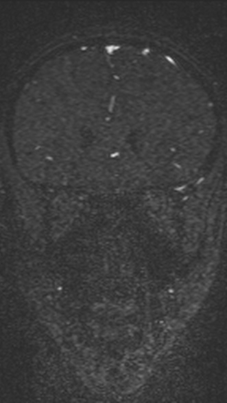 Normal MRI brain with MRV- teenager (Radiopaedia 49425-54553 Coronal MRV 86).jpg