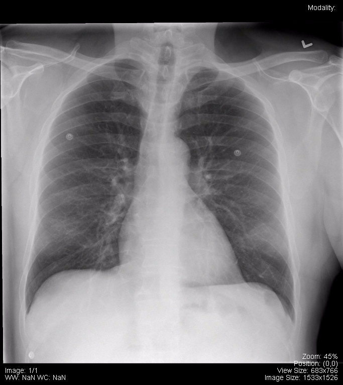 Normal PA Chest x-ray.png