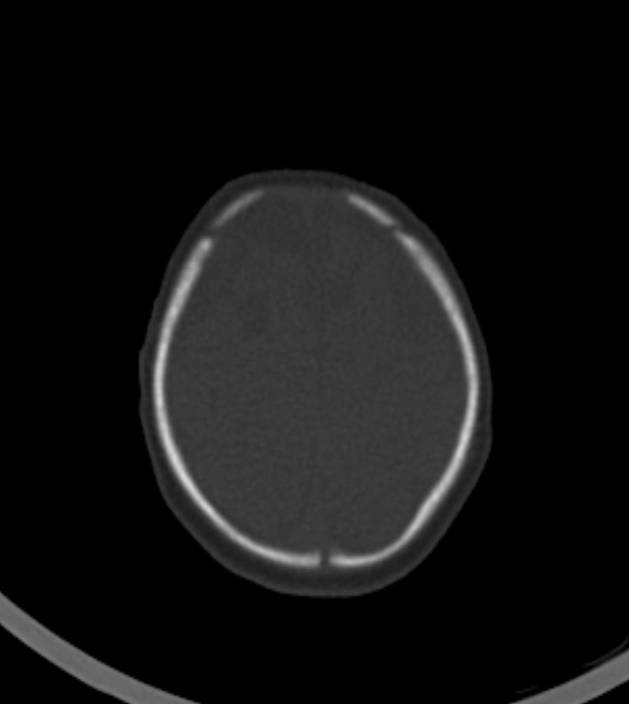 Normal brain CT - 2-month-old (Radiopaedia 53369-59350 Axial bone window 10).jpg