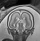 File:Normal brain fetal MRI - 22 weeks (Radiopaedia 50623-56050 Coronal T2 Haste 10).jpg