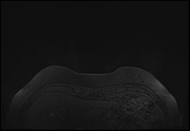 File:Normal breast MRI - dense breasts (Radiopaedia 80454-93850 Axial T1 5).jpg