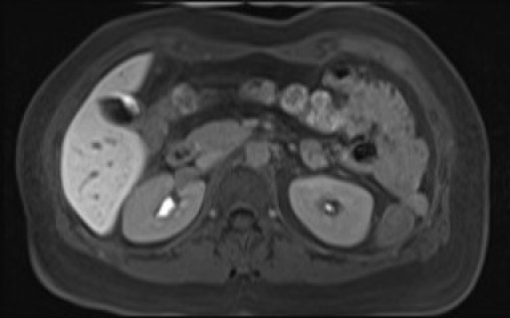 File:Normal hepatobiliary phase liver MRI (Radiopaedia 58968-66230 A 54).jpg