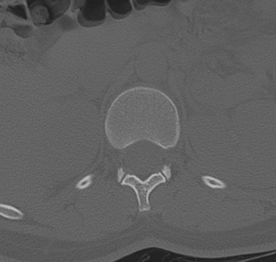 File:Normal lumbosacral CT (Radiopaedia 37923-39867 Axial bone window 27).png