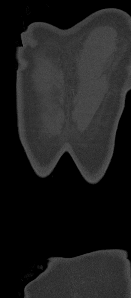 Normal thoracolumbar spine (Radiopaedia 43822-47309 Coronal bone window 96).png