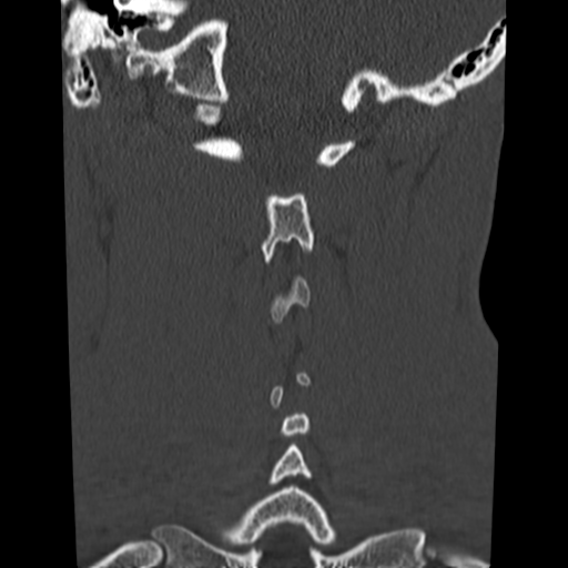 File:Normal trauma cervical spine (Radiopaedia 41017-43760 Coronal bone window 33).png