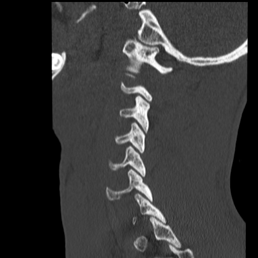 File:Normal trauma cervical spine (Radiopaedia 41017-43760 Sagittal bone window 37).png