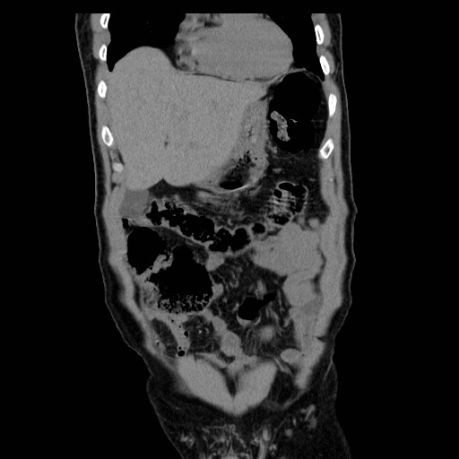 File:Obstructed kidney with perinephric urinoma (Radiopaedia 26889-27066 Coronal non-contrast 2).jpg