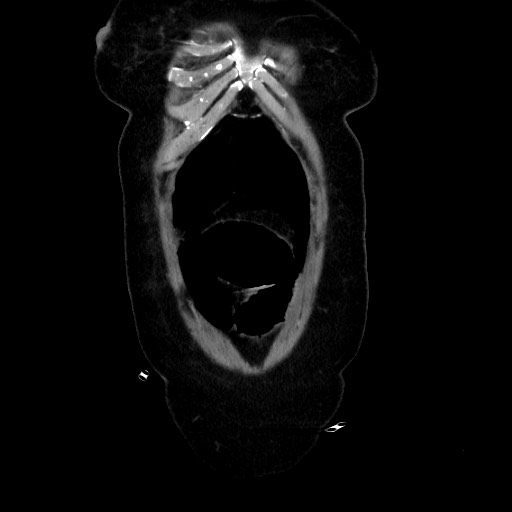Obstructive distal colonic adenocarcinoma causing cecal perforation (Radiopaedia 86830-102989 C 44).jpg