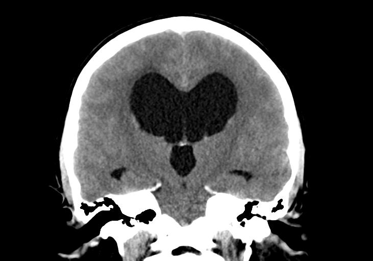 File:Obstructive hydrocephalus (Radiopaedia 30453-31119 Coronal non-contrast 21).jpg