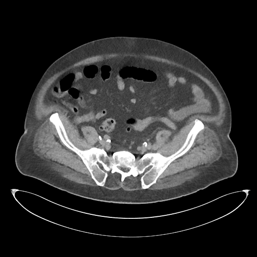 File:Obstructive pyelonephritis (Radiopaedia 46411-50844 Axial non-contrast 59).png