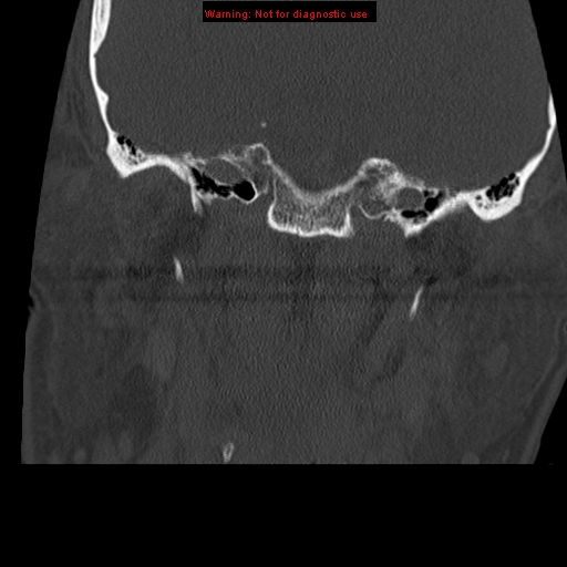File:Occipital condyle fracture (Radiopaedia 18366-18208 Coronal bone window 1).jpg
