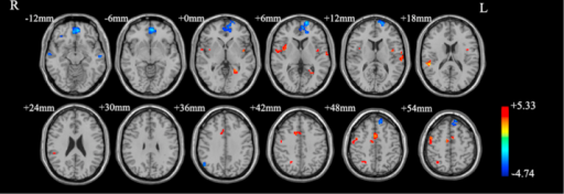 Brain regions showing different functional connectivity between obsessive–compulsive disorders and controls