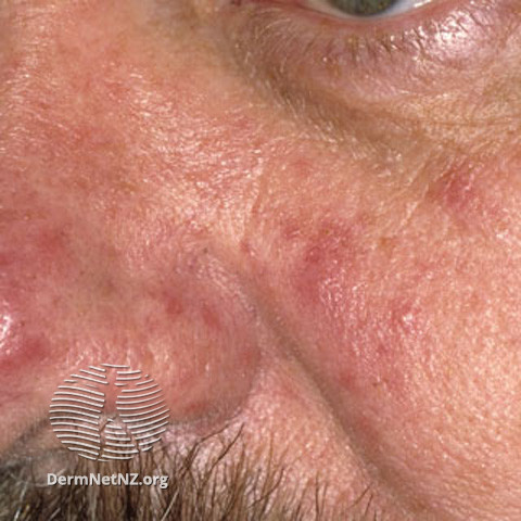 Rosacea (DermNet NZ acne-red-face-3606).jpg