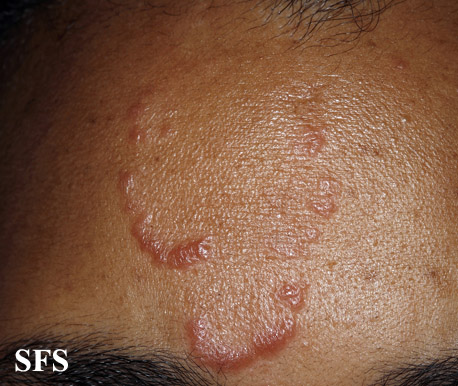 File:Sarcoidosis (Dermatology Atlas 21).jpg