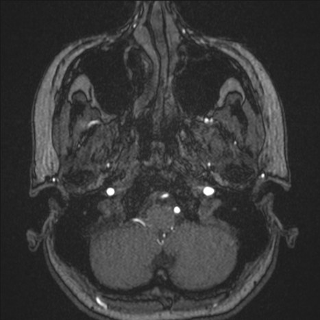 A1 segment hypoplasia (Radiopaedia 83365-97781 Axial TOF MRA 6).jpg