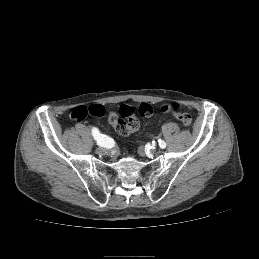 File:Abdominal aortic aneurysm (Radiopaedia 13341-13340 Axial C+ arterial phase 194).jpg