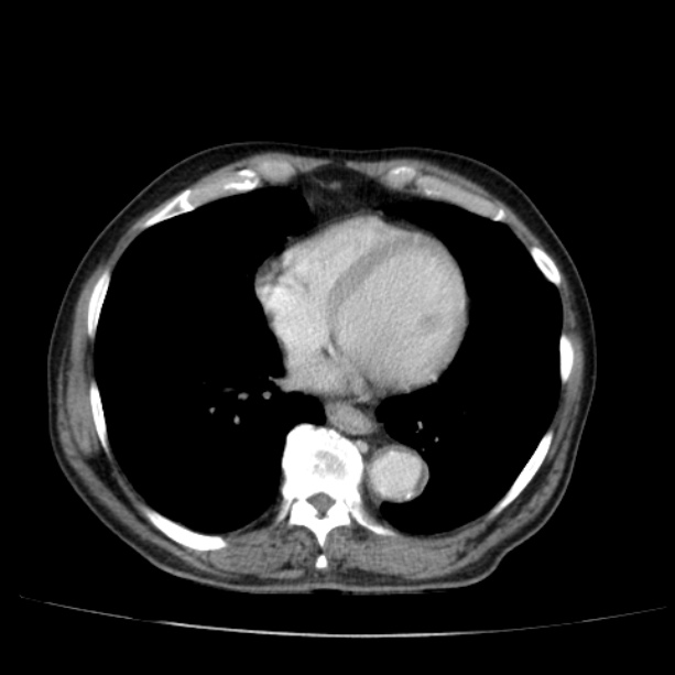 Abdominal aortic aneurysm (Radiopaedia 29248-29660 Axial C+ portal venous phase 2).jpg