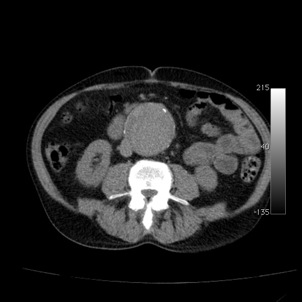 Abdominal aortic aneurysm (Radiopaedia 29248-29660 Axial non-contrast 31).jpg