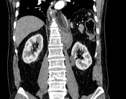 Abdominal aortic aneurysm (Radiopaedia 67117-76452 Coronal C+ arterial phase 71).jpg