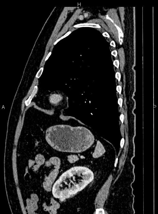Abdominal aortic aneurysm (Radiopaedia 83094-97462 Sagittal renal cortical phase 94).jpg
