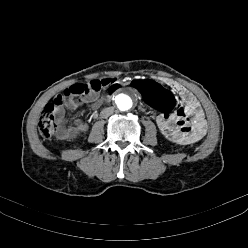 File:Abdominal aortic aneurysm (Radiopaedia 83581-98689 Axial C+ arterial phase 67).jpg