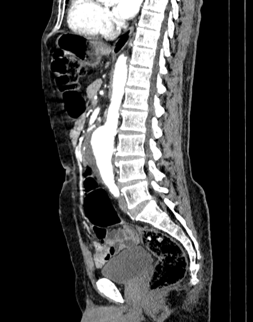 Abdominal aortic aneurysm (Radiopaedia 83581-98689 Sagittal C+ arterial phase 48).jpg