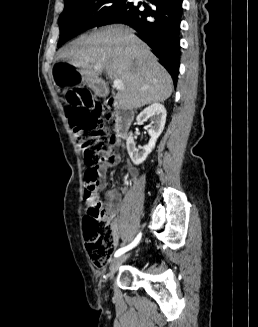Abdominal aortic aneurysm (Radiopaedia 83581-98689 Sagittal C+ arterial phase 5).jpg
